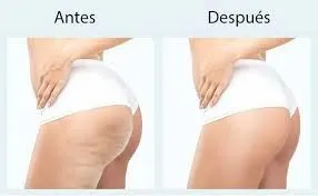 Sculptra: Tratamiento no invasivo para glúteos perfectos